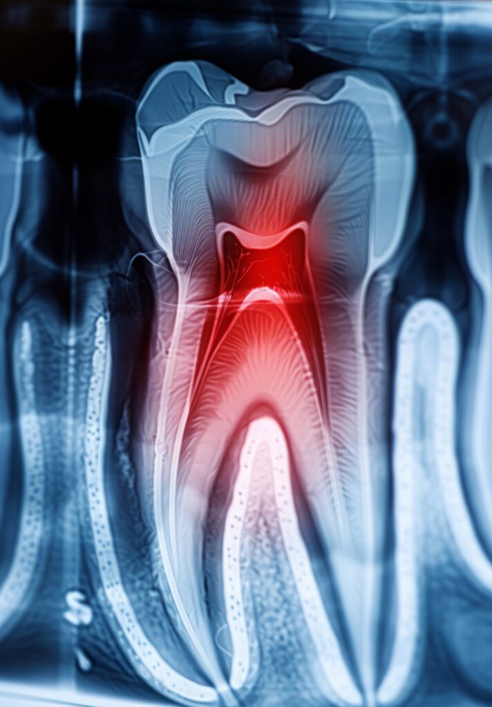 X-ray of a diseased tooth.