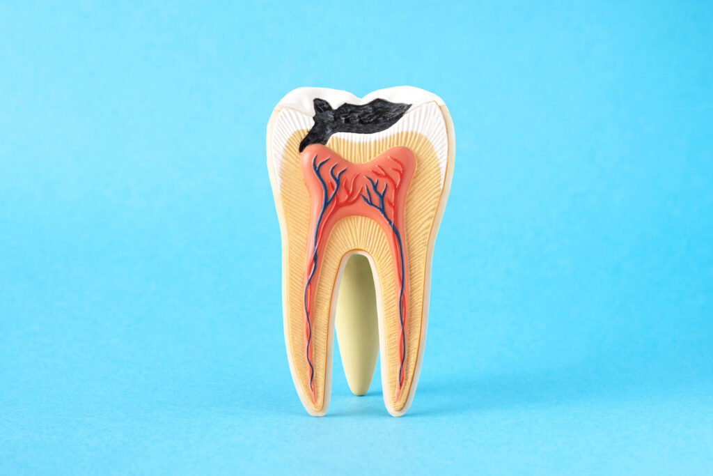 Close-up internal tooth structure model with fisrt step of caries decay on blue background