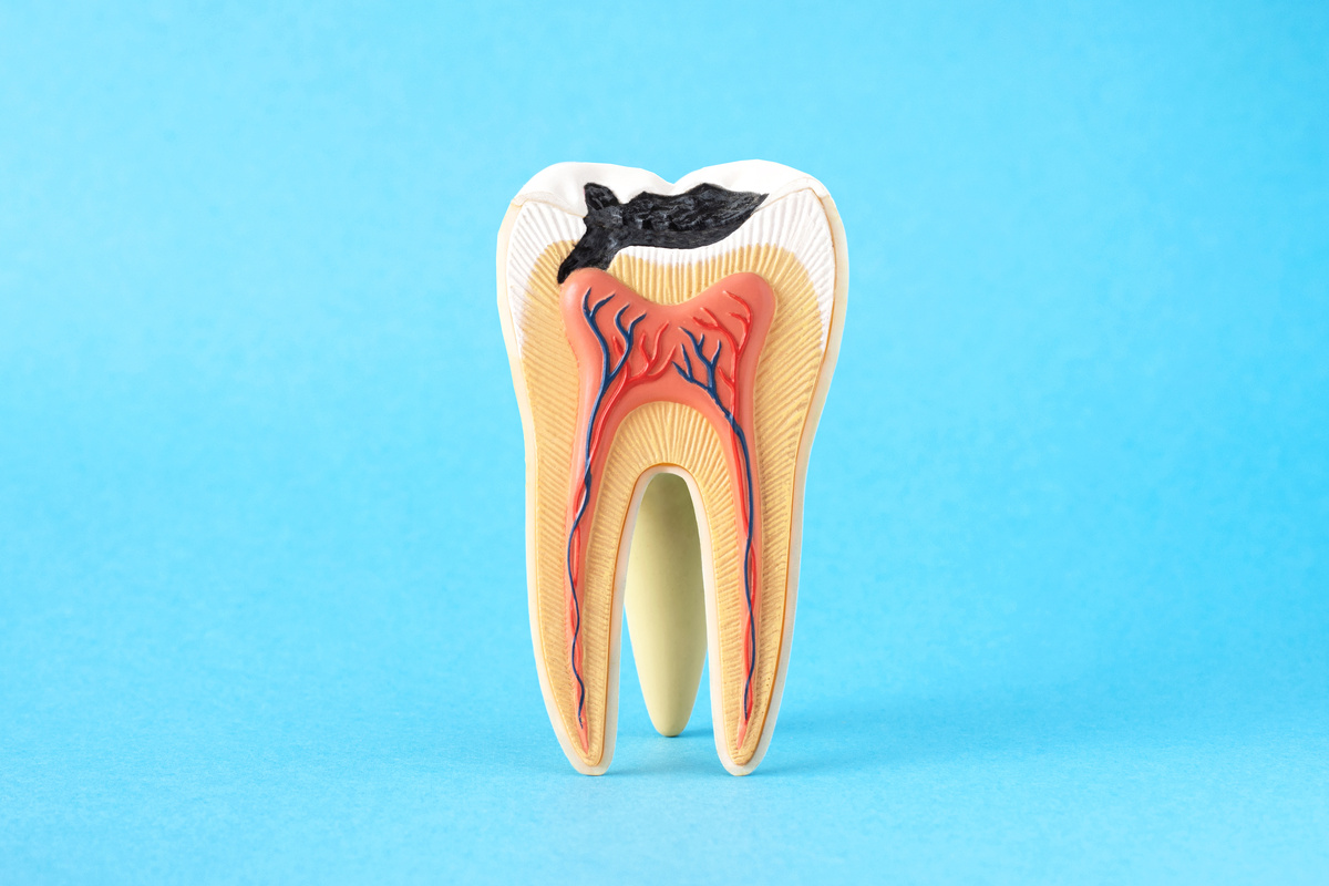 Close-up internal tooth structure model with fisrt step of caries decay on blue background