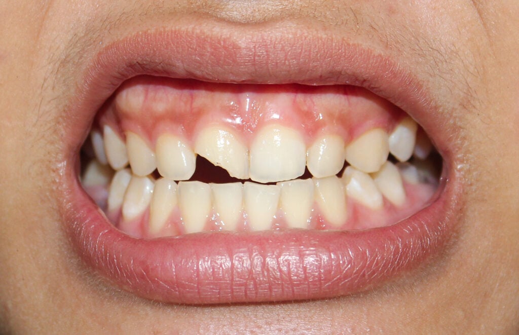 Close-up of a broken tooth with visible cracks and damage. The fractured enamel and dentin expose the tooth’s inner layers, highlighting dental injury and oral health concerns.