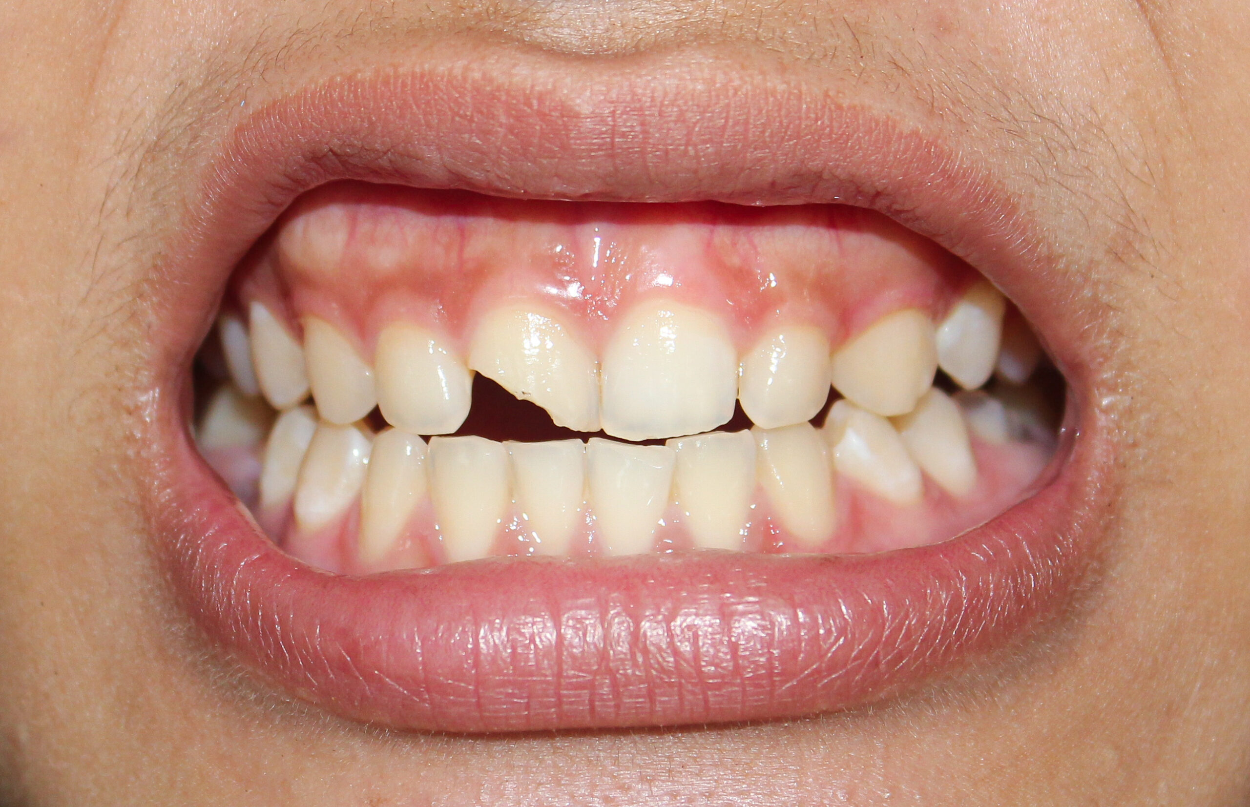 Close-up of a broken tooth with visible cracks and damage. The fractured enamel and dentin expose the tooth’s inner layers, highlighting dental injury and oral health concerns.